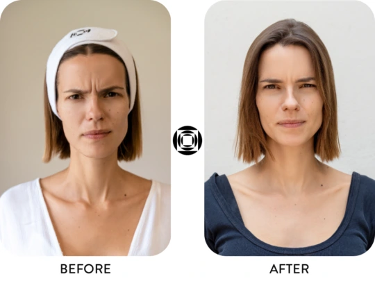 mos-toxina-botulinica-before-after
