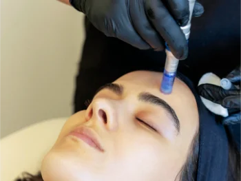 Microneedling - Coctail MOS